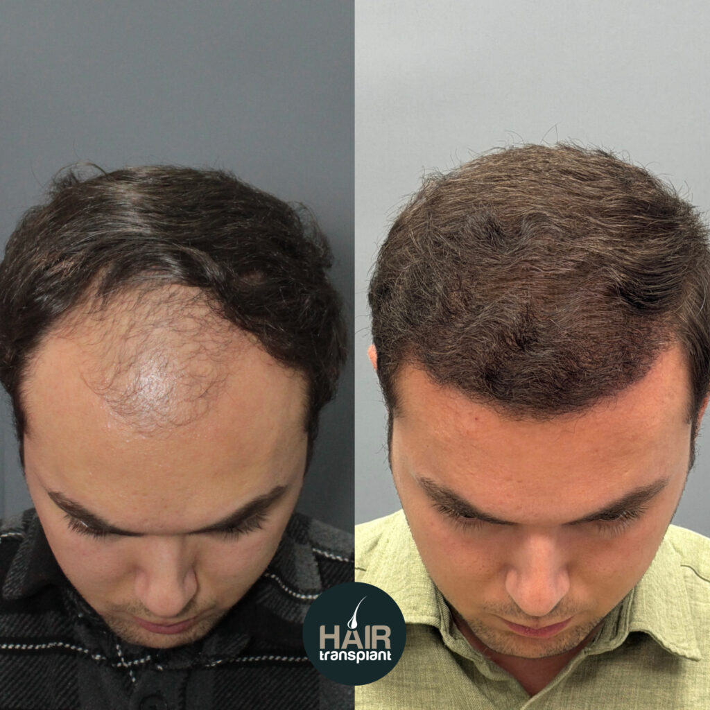 hair transplant