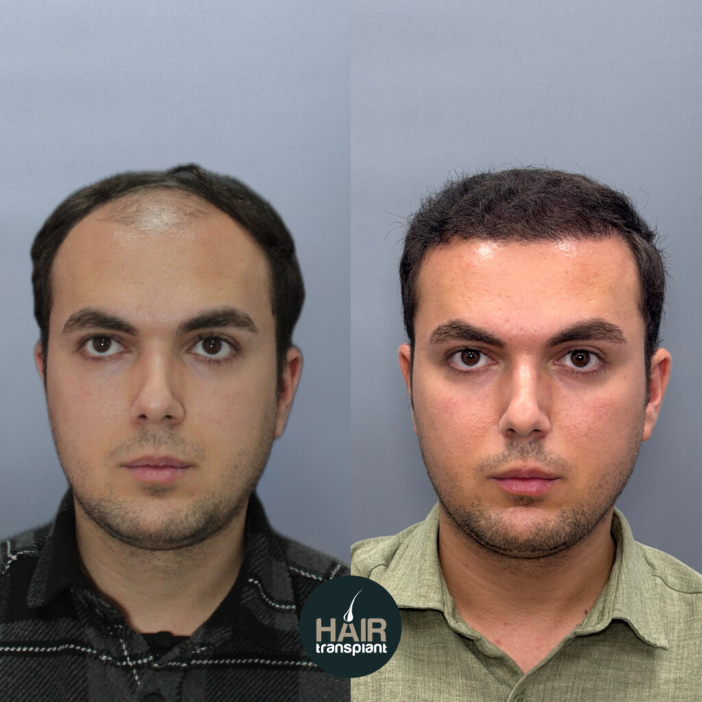 transplanting hair